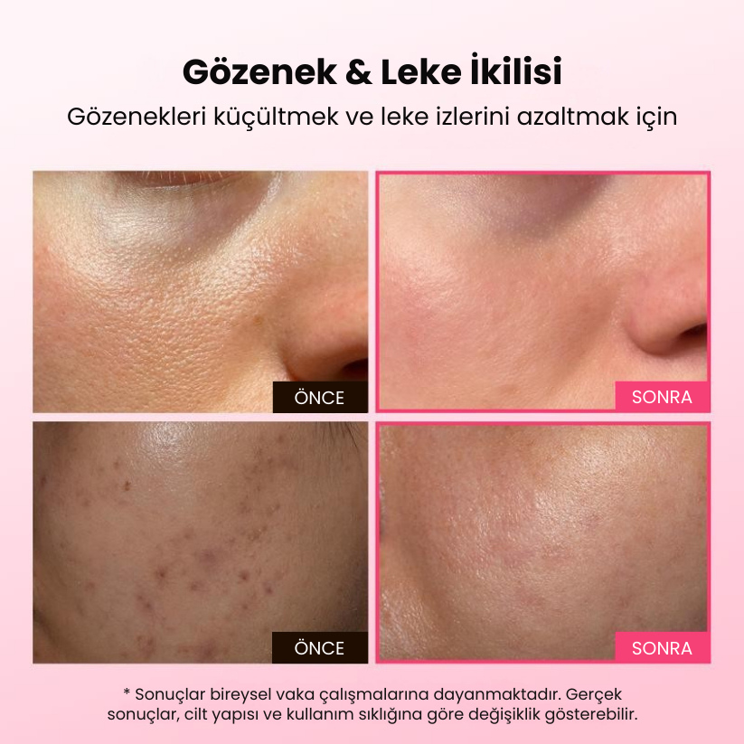 Gözenek ve Leke Karşıtı İkili – Gözenekleri Sıkılaştırır, Lekeleri Azaltır, Işıltılı Bir Cilt Sunar